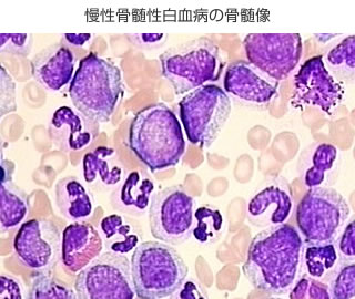 慢性骨髄性白血病の骨髄像